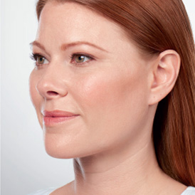 After Kybella