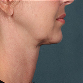 After Kybella