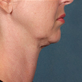 Before Kybella